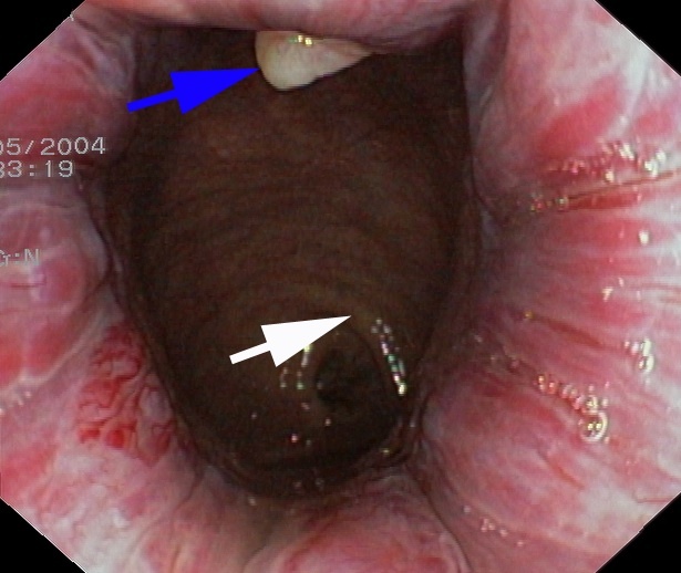 Endoscopic View Of Sex 112