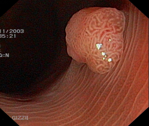 What is a sessile polyp?