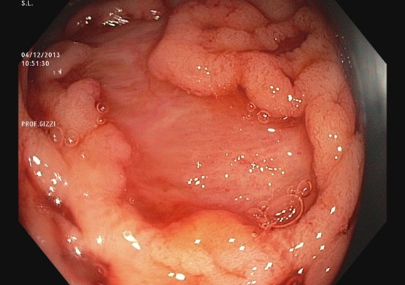 Crohn Colitis