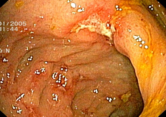 Crohn Colitis Mild