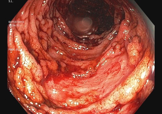 Crohn Colitis Severe