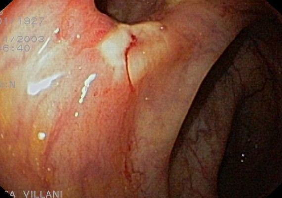 Crohn Colonic Stenosis