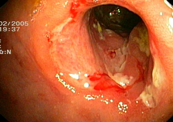 Crohn Colonic Stenosis