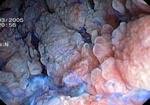 Crohn Ileitis - Close View
