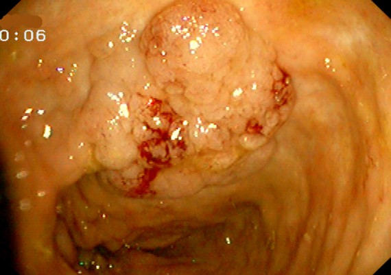 DALM in Ulcerative Colitis