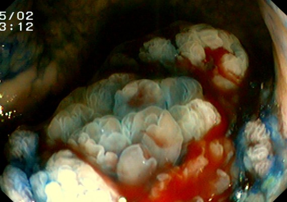 DALM in Ulcerative Colitis - Close View