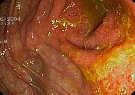 Ulcerative Colitis Cecal Patch