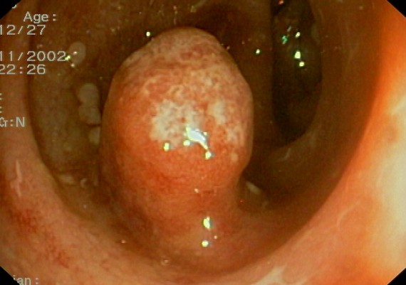 Ulcerative Colitis - Inflammatory Polyp