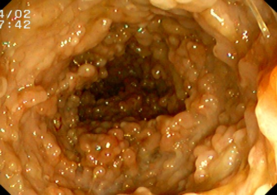 Ulcerative Colitis - Inflammatory Polyposis