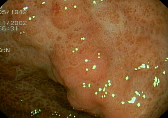 Ulcerative Colitis - Inflammatory Polyposis