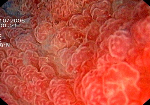 Ulcerative Colitis Magnified View
