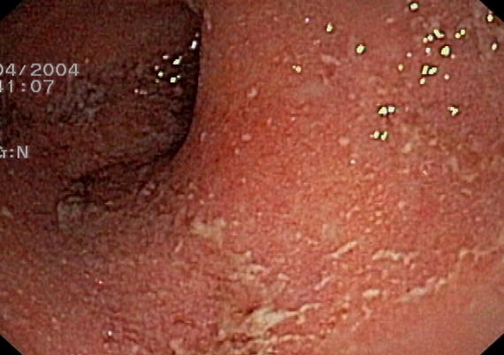 Ulcerative Colitis Mild