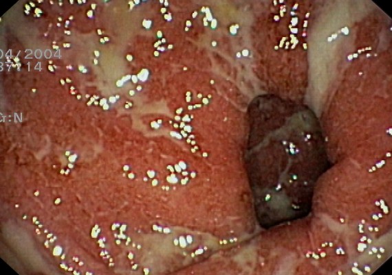 Ulcerative Colitis Moderate