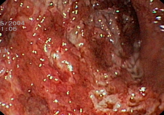 Ulcerative Colitis Severe