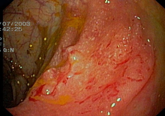 Ulcerative Colitis - Skip Lesion